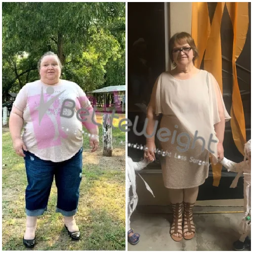 Gastric Sleeve Before and After Joy B - 2 Year Update*